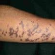 Lichen Planus image 2