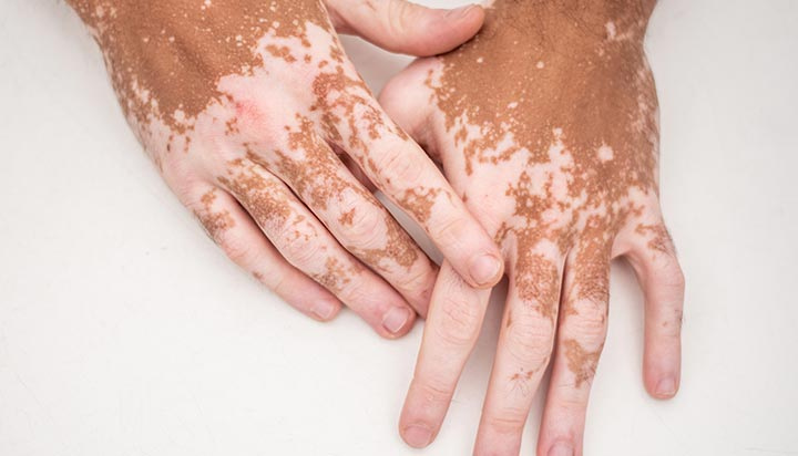 Vitiligo image 1
