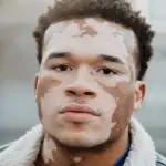 Vitiligo image 2